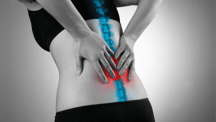 sciatica