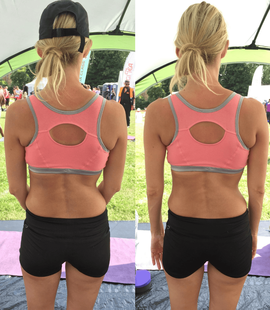Scoliosis 1
