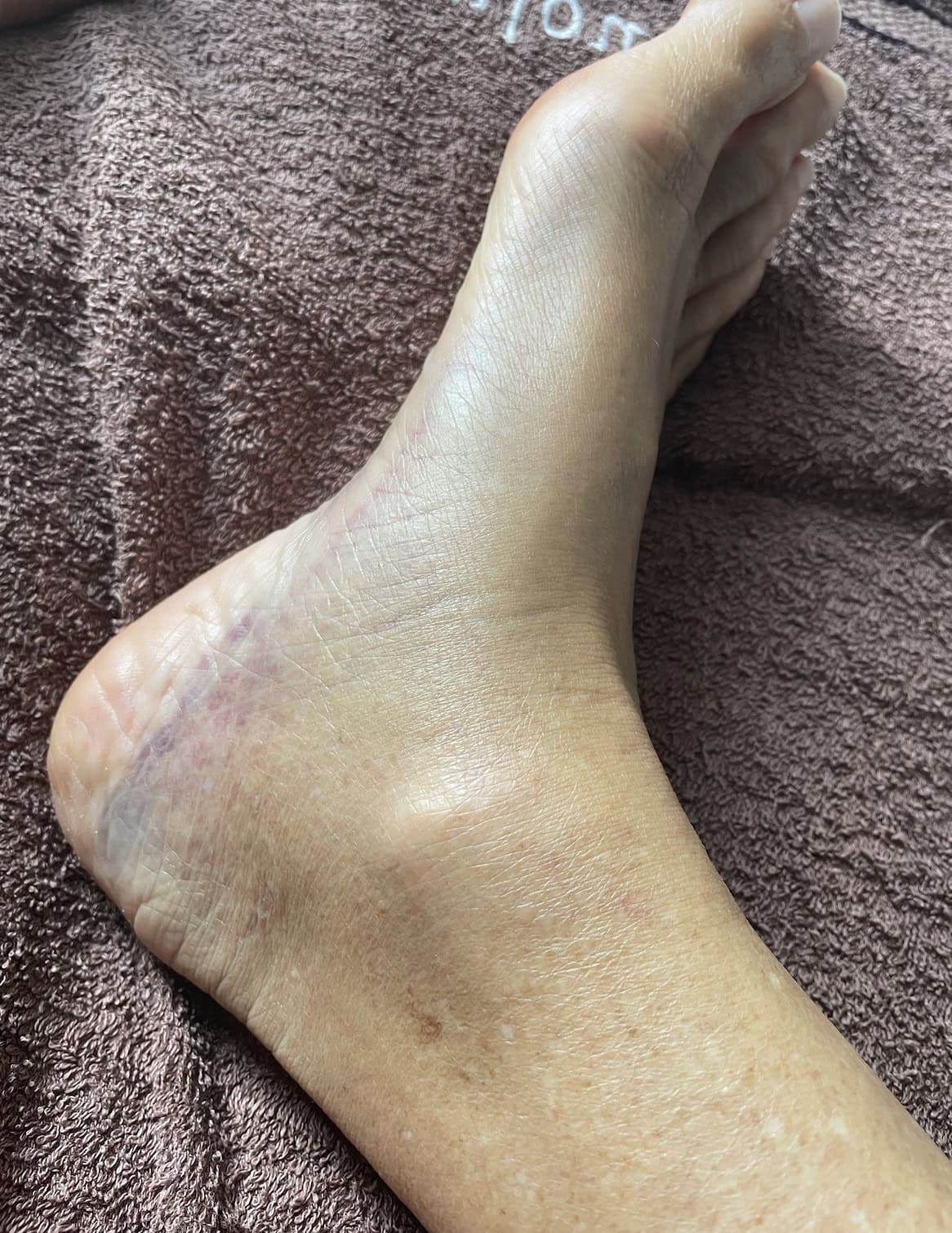 Image showing how blood has drained into the foot and ankle after a calf injury